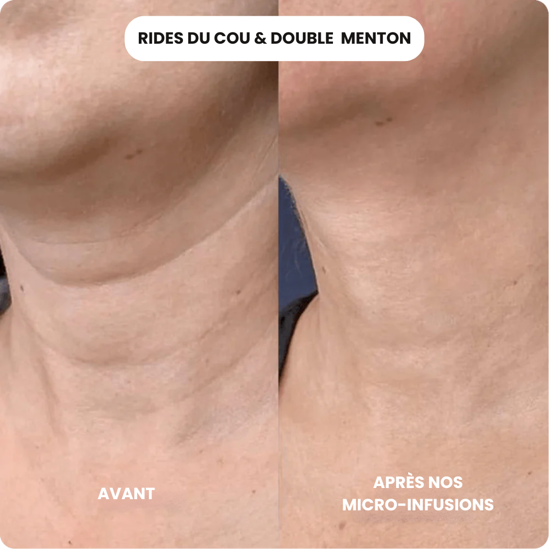 Micro Infusion Anti Âge